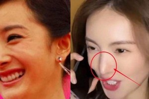 女明星隆鼻后遗症：杨幂车晓鼻孔外翻，鞠婧祎鼻梁透光